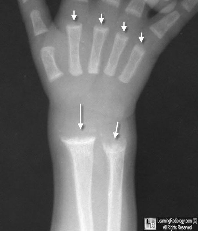 Radiological Findings in Rickets