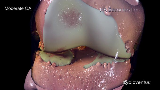 Stages of Knee Osteoarthritis
