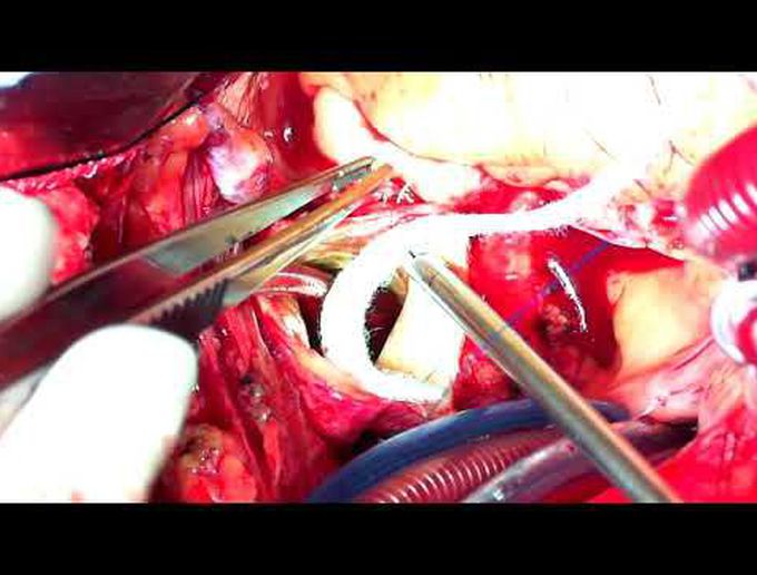 Aortic Dissection Repair: Tips and Tricks