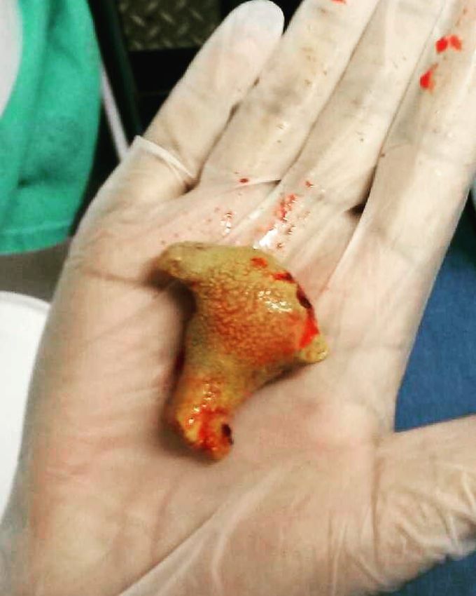 KIDNEY STONE