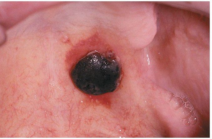 Thrombocytopenia