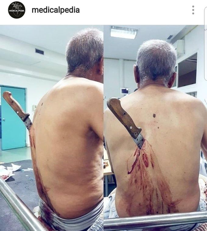 A Case of man stabbed in the back.
