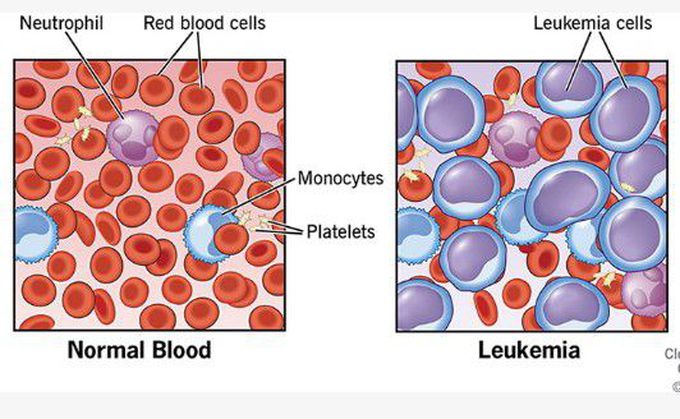 Leukemia