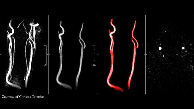 Non-Contrast Enhanced Magnetic Resonance Arteriography&nbsp;