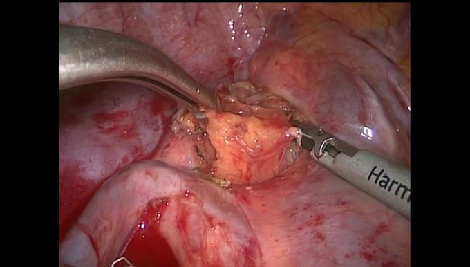 Harmonic HD–Powered Right Upper Lobectomy