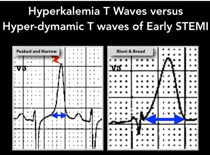 Types Of T Waves