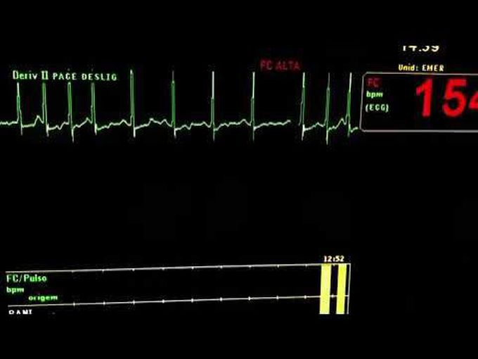 Electrocardiographic Monitoring during Speech-Induced Atrial Tachycardia