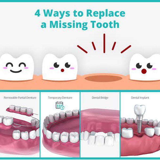 How to replace a missing tooth