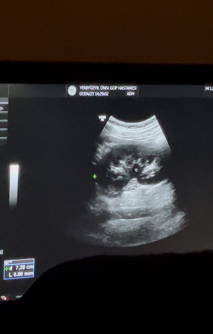 Kidney ultrasound