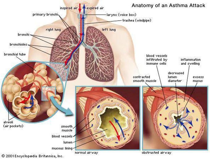 Asthma Treatment