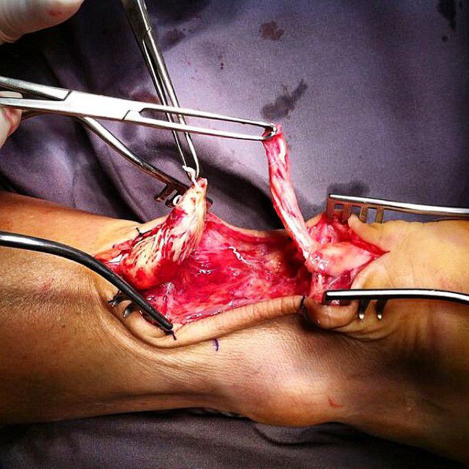 Achilles' tendon repair surgery