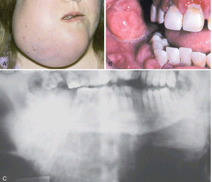 Osteosarcoma