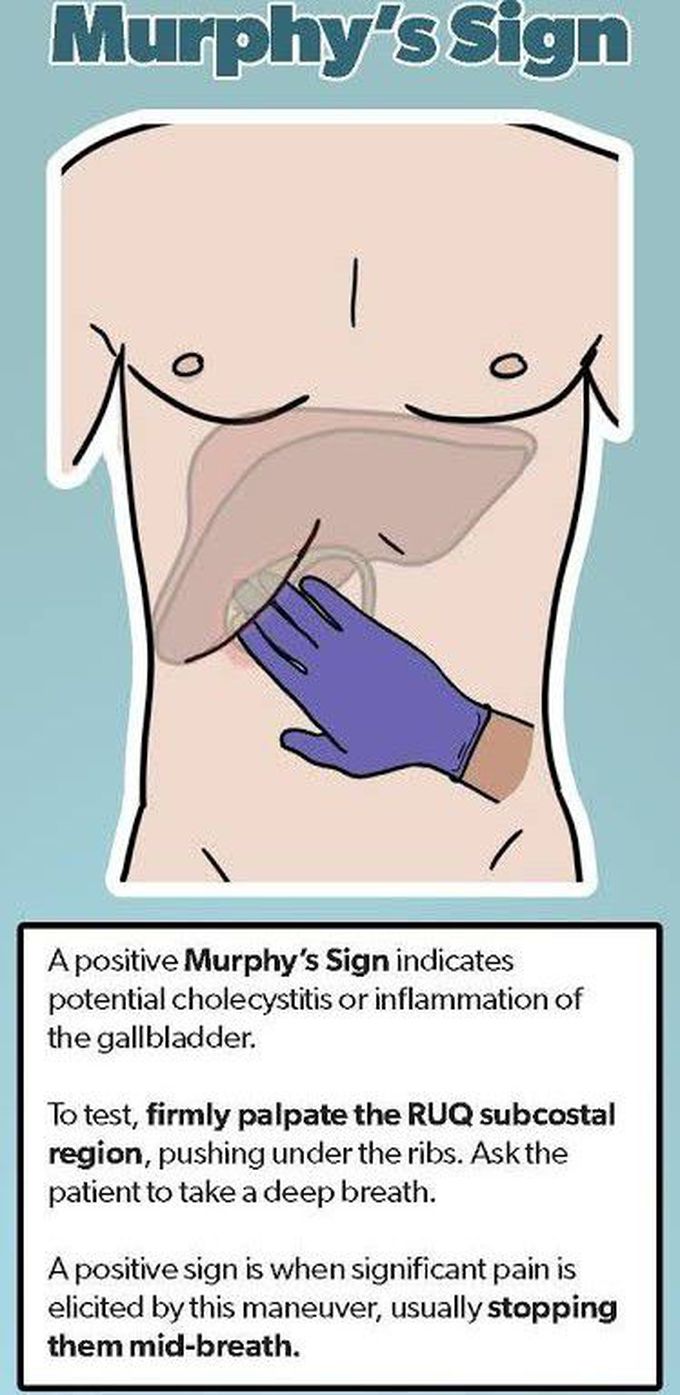 Murphy's sign