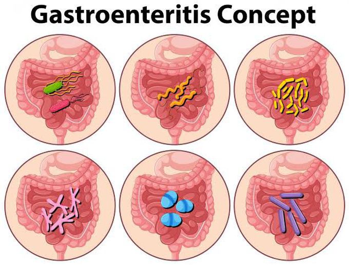 Viral gastroenteritis