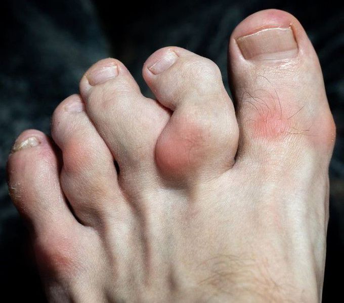 Proinflammatory diets and Gout