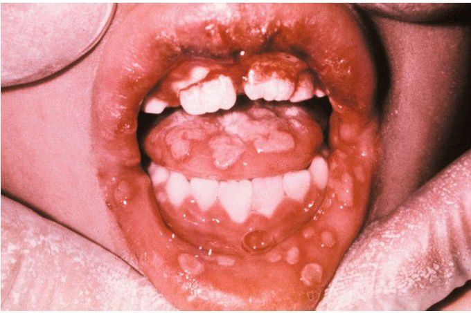 Acute Herpetic Gingivostomatitis