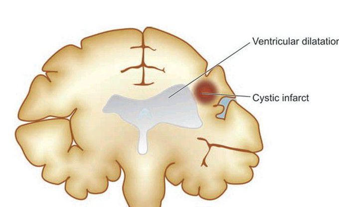 Cystic infarction