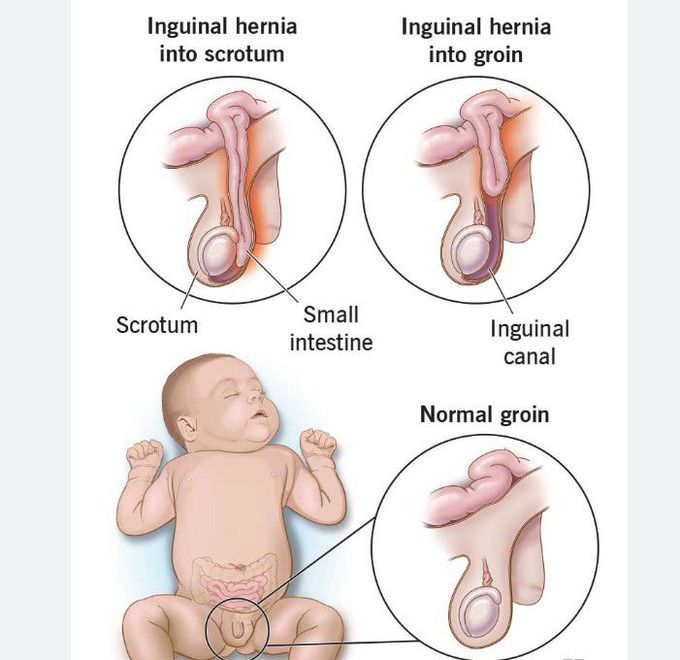 Cause of Inguinal hernias