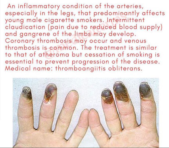 Buerger’s disease