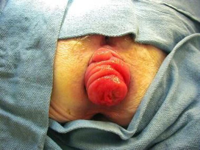 Etiology of Rectal Prolapse in Children
