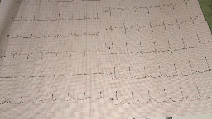 ECG OF 50 YEAR OLD😷🤪😳👤