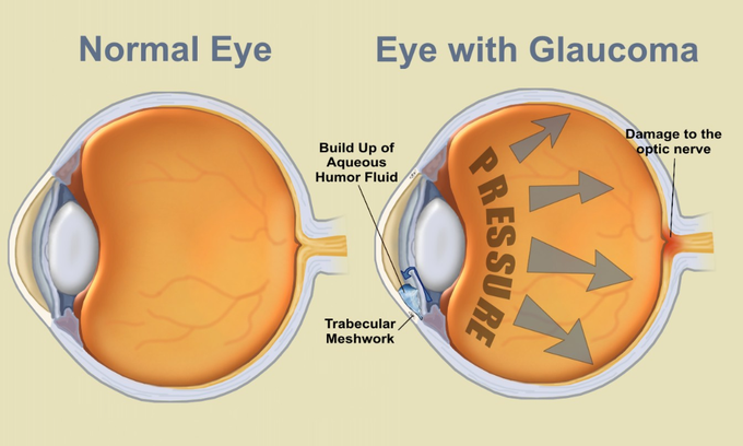 Glaucoma