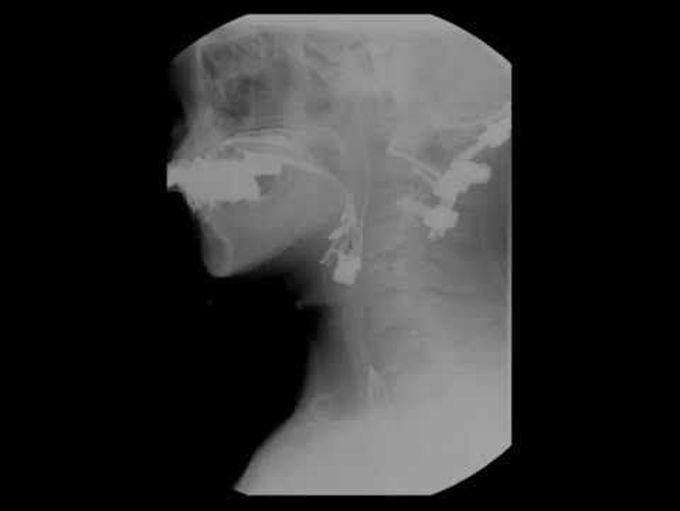Videofluoroscopic Studies with Barium *Dysphagia after Occipitocervical Fusion

*