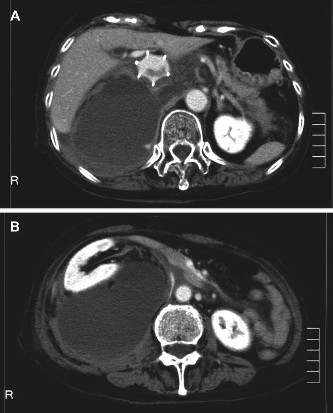 What You Can’t See Can Actually Kill: Retroperitoneal Hematoma