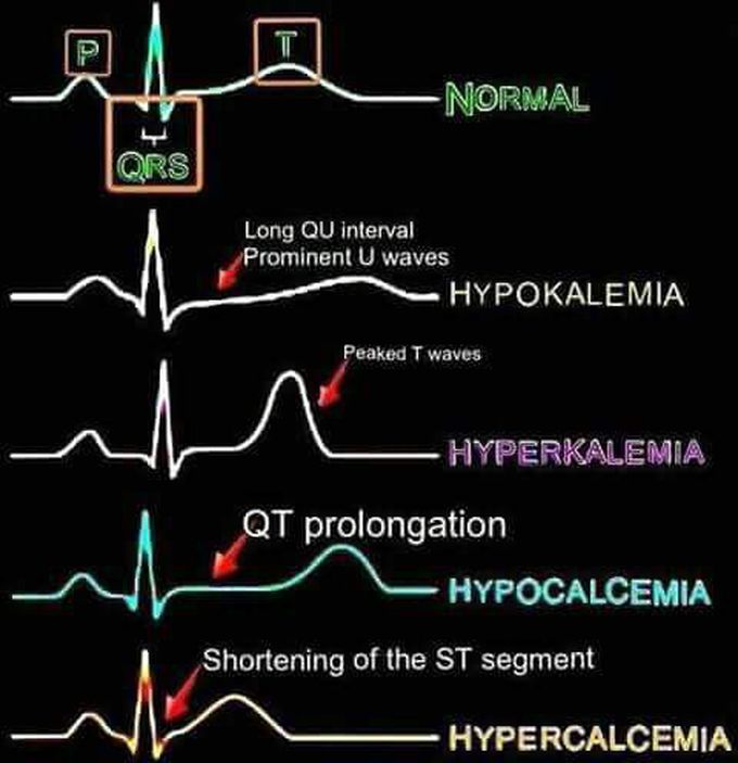 EKG - MEDizzy