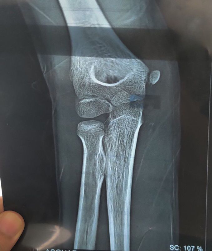 X-ray of an elbow in a 10 year old boy with the history of fall. Can you spot any finding?