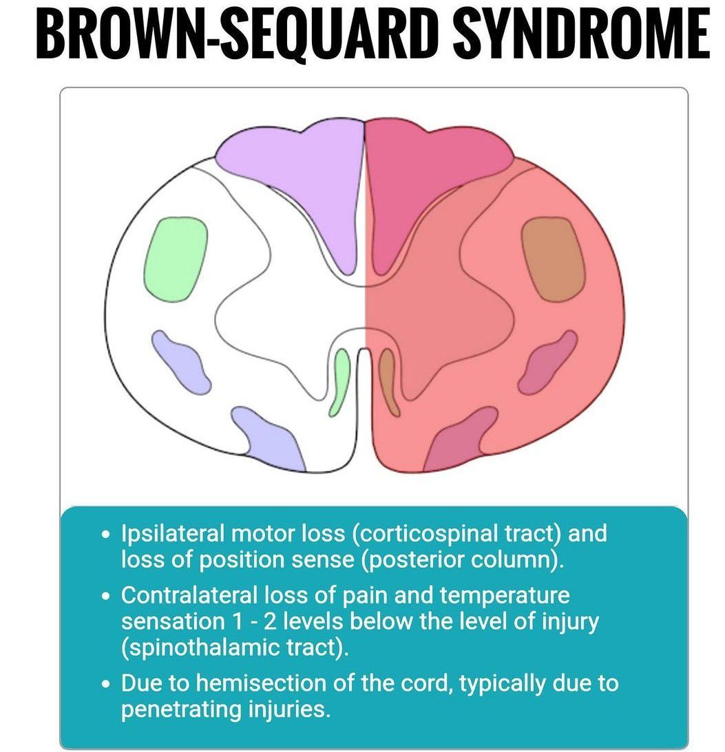 Brown Sequard Syndrome - MEDizzy