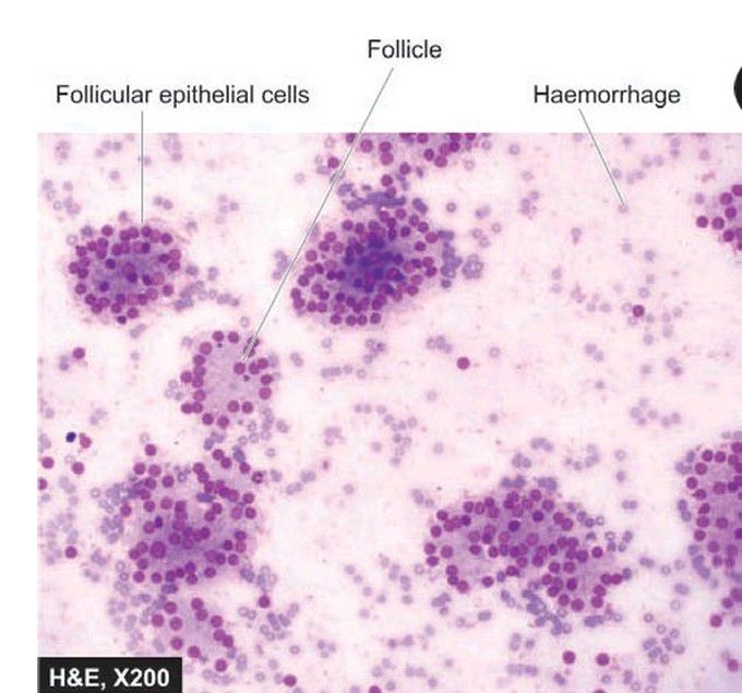 Follicular neoplasm.