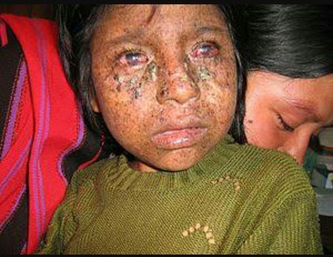 Xeroderma pigmentosum