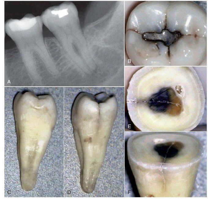 Cracked tooth