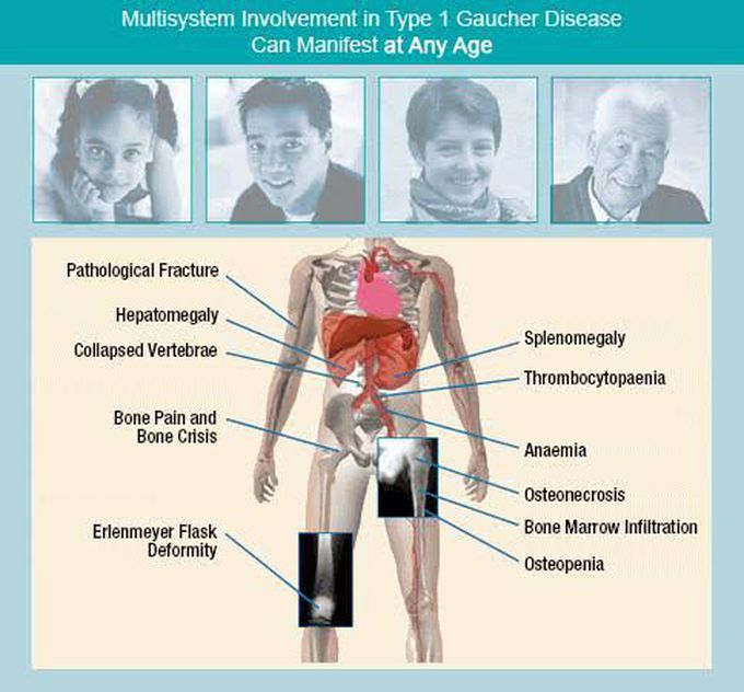 Symptoms of gaucher's disease