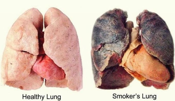 Healthy Lung vs. Smoker's Lung