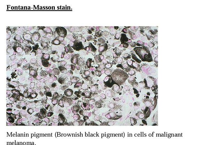 Malignant melanoma cells-Fontana mason staining