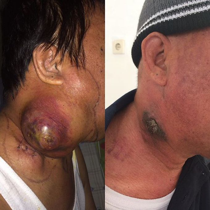 After 2 cycles of chemotheraphy
