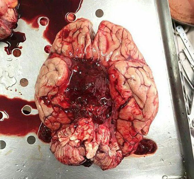 Cerebral hemorrhage