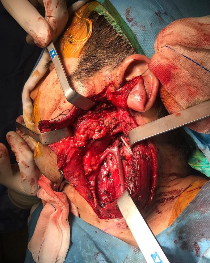 Parotidectomy for a pleomorphic adenoma tumor in the parotid gland!