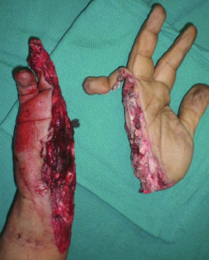 24-year-old mill worker sustained a mutilating injury to his dominant, right hand, resulting in a complete amputation of the radial aspect of his hand. 