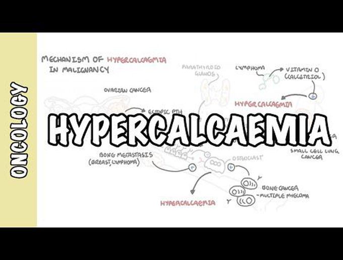 Hypercalcemia - (Oncology emergency) causes, pathophysiology, symptoms, treatment