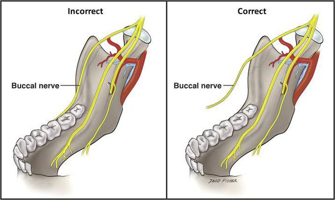 Long buccal nerve