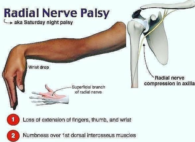 Radial Nerve Palsy