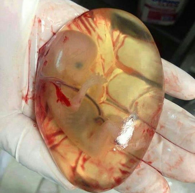 Undeveloped Fetus