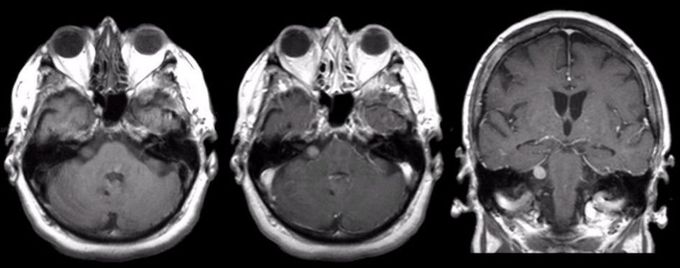 Acoustic Neuroma