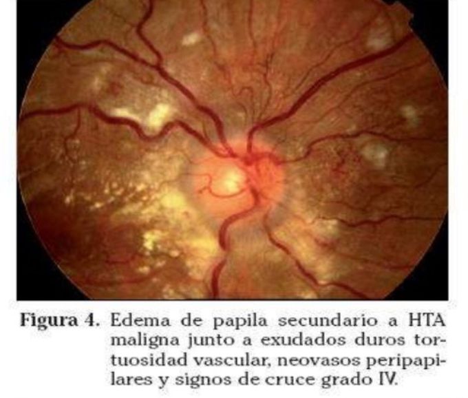Edema de papila