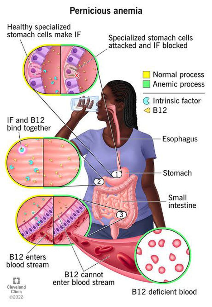 Is Low B12 Always Pernicious Anemia