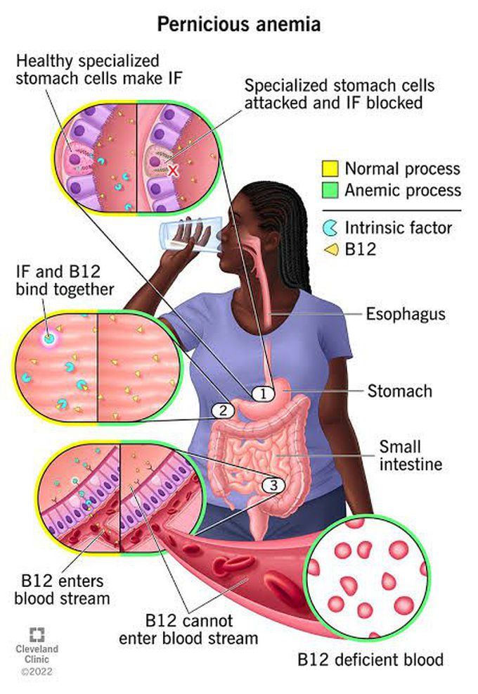 Pernicious Anemia