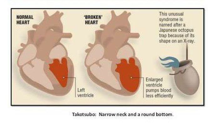 💔💔BROKEN HEART SYNDROME 💔💔